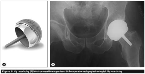 bearing surfaces in total hip arthroplasty ppt|Total hip arthroplasty: Techniques and results.